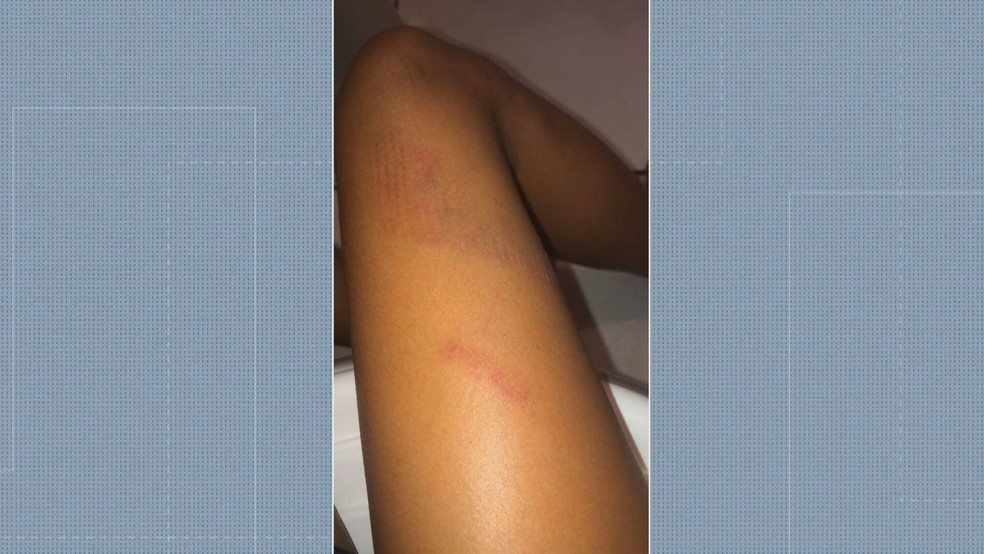 Menina de 12 anos ficou com marcas na perna após agressão dentro de escola municipal em Bangu — Foto: Reprodução: Redes sociais