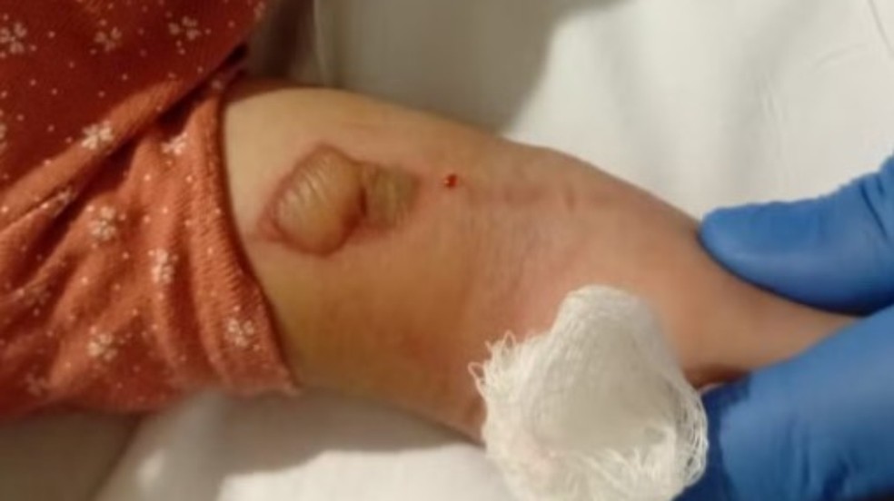 Marcas no braço do bebê — Foto: Acervo pessoal/Rayanna Brito