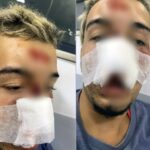 Ciclista perde dentes após cair em buraco em ciclovia de Japeri; Família relata falta de iluminação no local do acidente