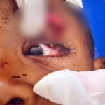 Menino de 6 anos perde a visão após ser atingido por estilhaços durante ação na Mangueira