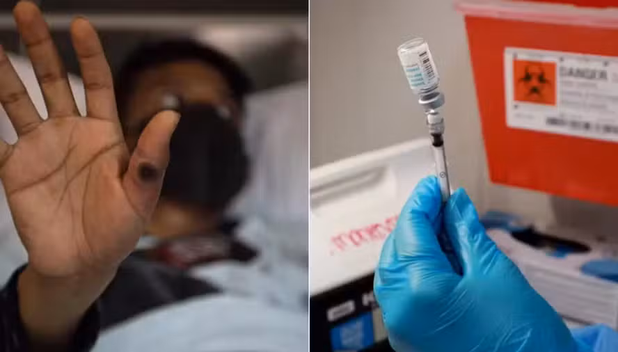 Casos de Mpox disparam no Rio de Janeiro e acendem alerta das autoridades de saúde
